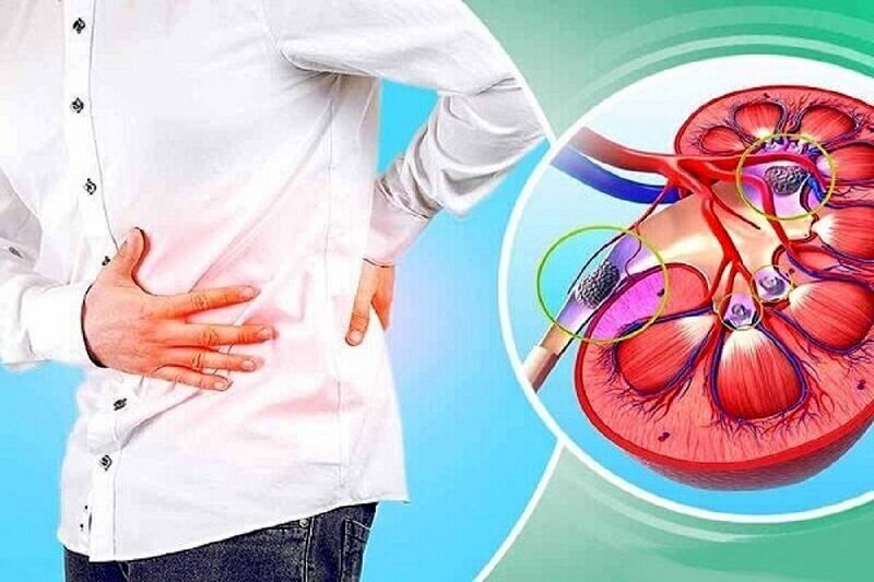 این نوشیدنی را برای فرار از سنگ کلیه نخورید! | ماءالشعیر دشمن سنگ کلیه است یا دوست آن؟